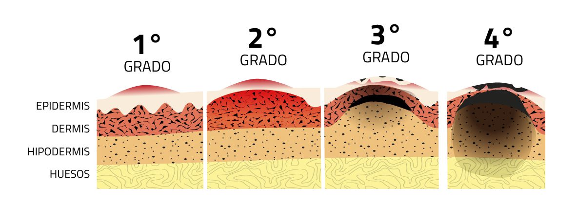 grados de las quemaduras