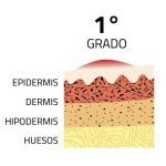 quemaduras de primer grado