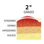 quemaduras de segundo grado