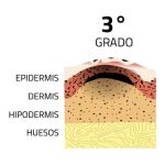 quemaduras de tercer grado