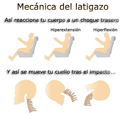 mecanismo del latigazo cervical